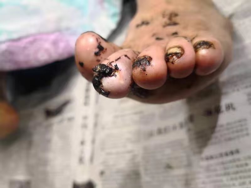 治疗后脚部已消肿,创面愈合(黑色的为外敷中药残留)日前,记者在病房里