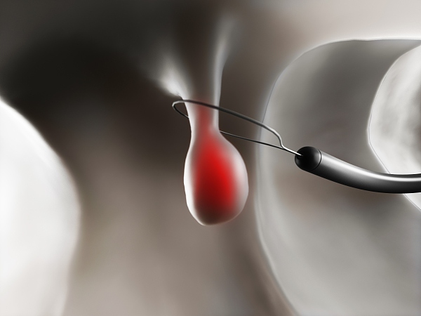 体检发现胆囊息肉怎么办 听听医生的四步法