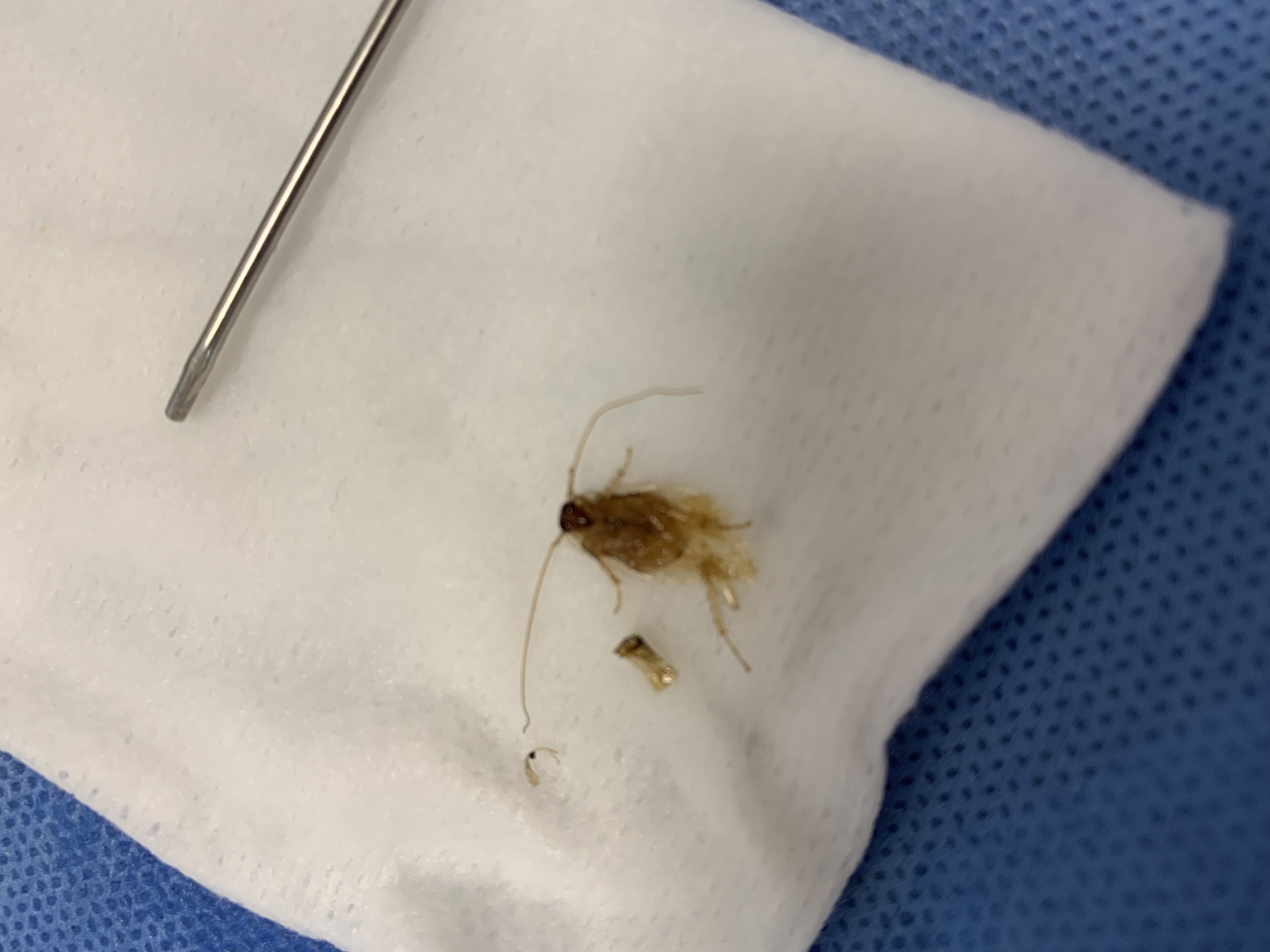 小姐姐马尔代夫度假,五天后耳内取出一只"小强"