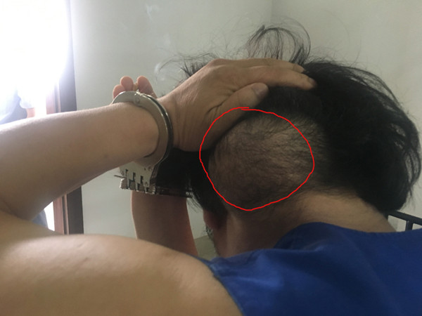 为了遮盖后脑勺的肿瘤,刘发特意留了长发.