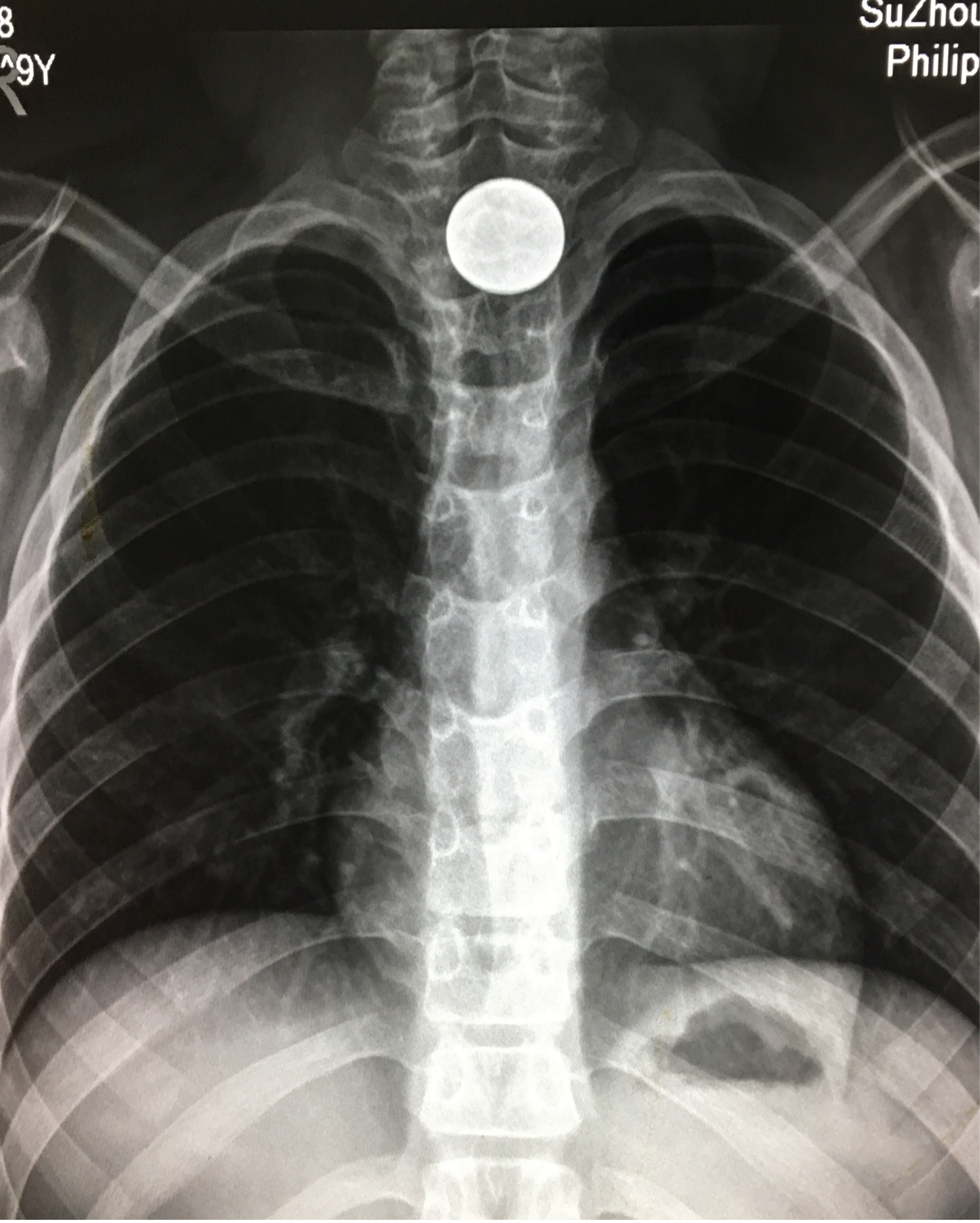 因误吞一元硬币苏州九岁女孩被卡得面红耳赤