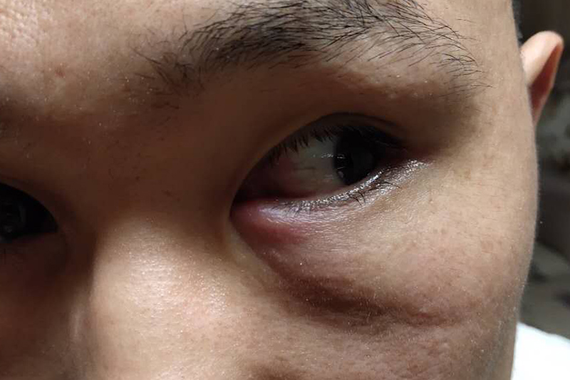 在足疗店按摩眼部致双眼发炎 市民讨说法获赔500元